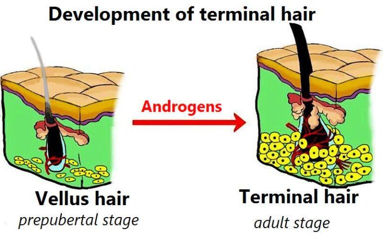 Vellus hair to Terminal hair